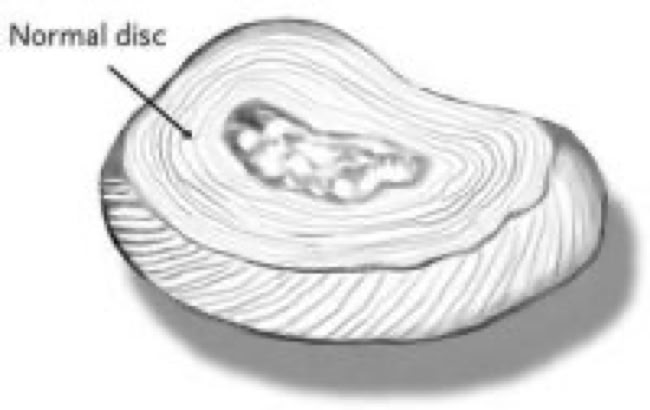 normal disc