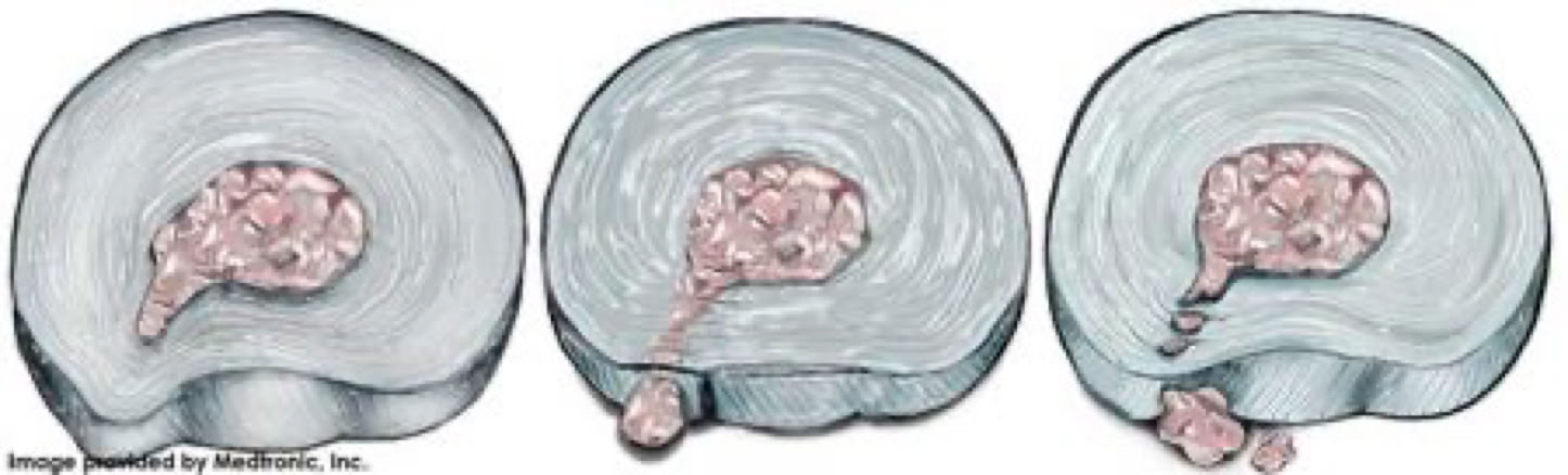 levels of disc herniation