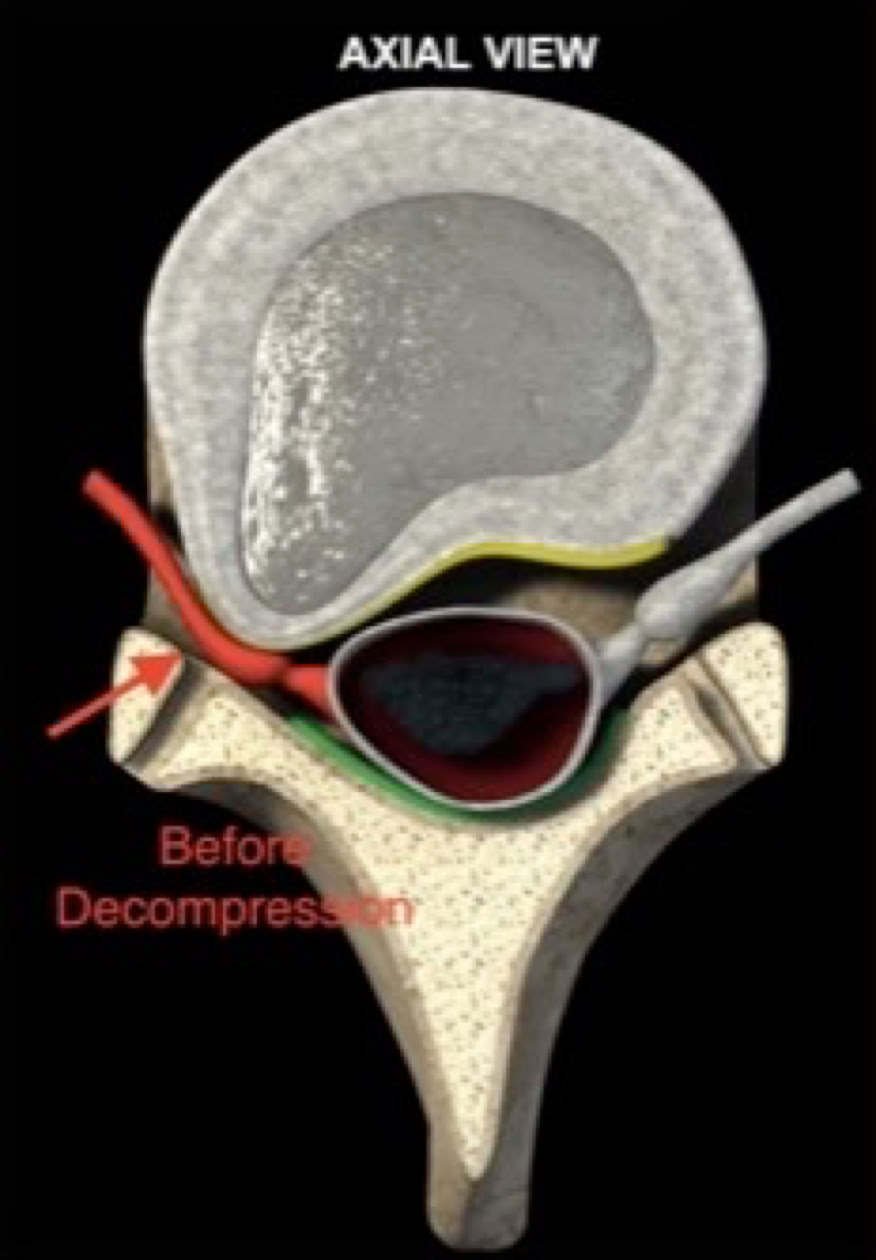 Disc herniation pressing on the nerve