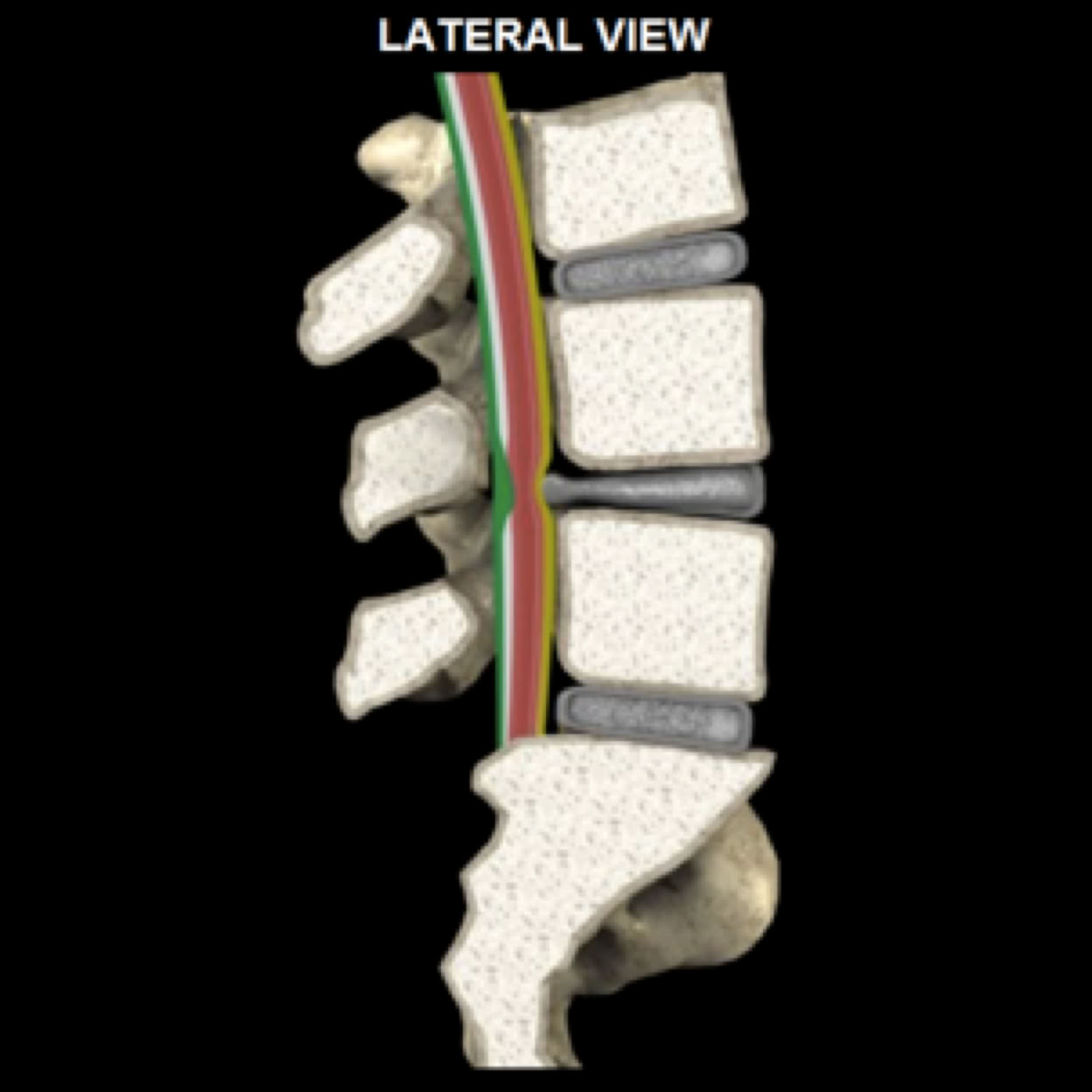 spinal stenosis