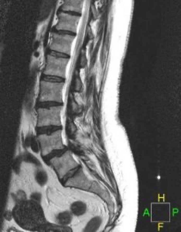 Lumbar spine stenosis