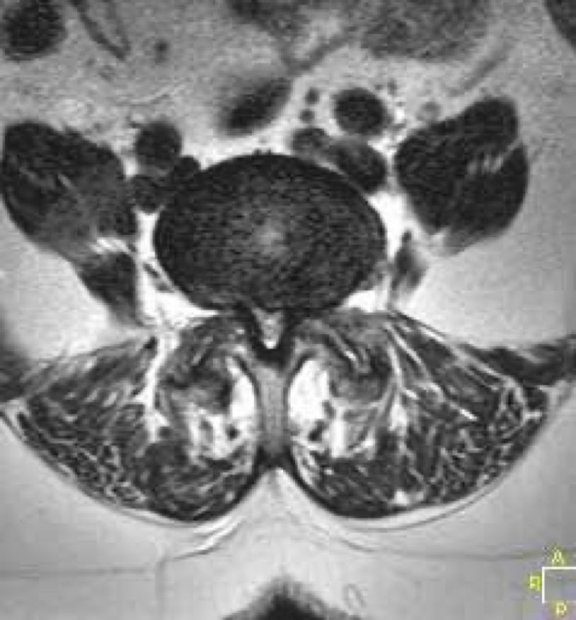 lumbar canal stenosis axial view