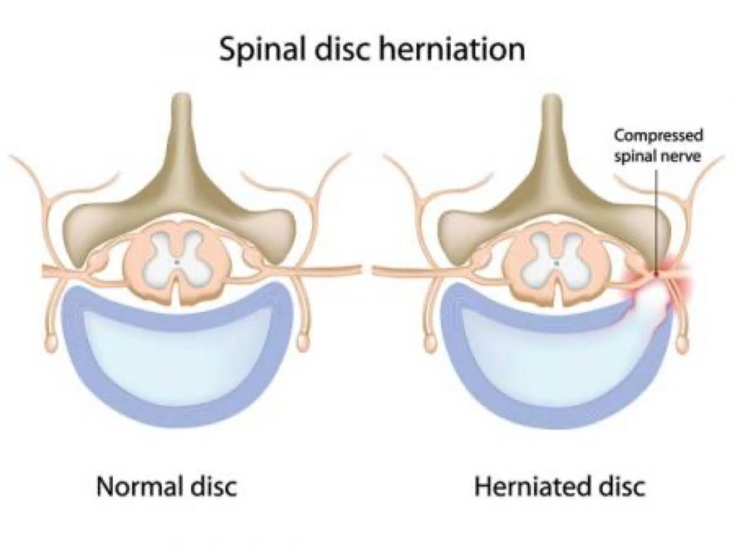 normal vs disc herniation