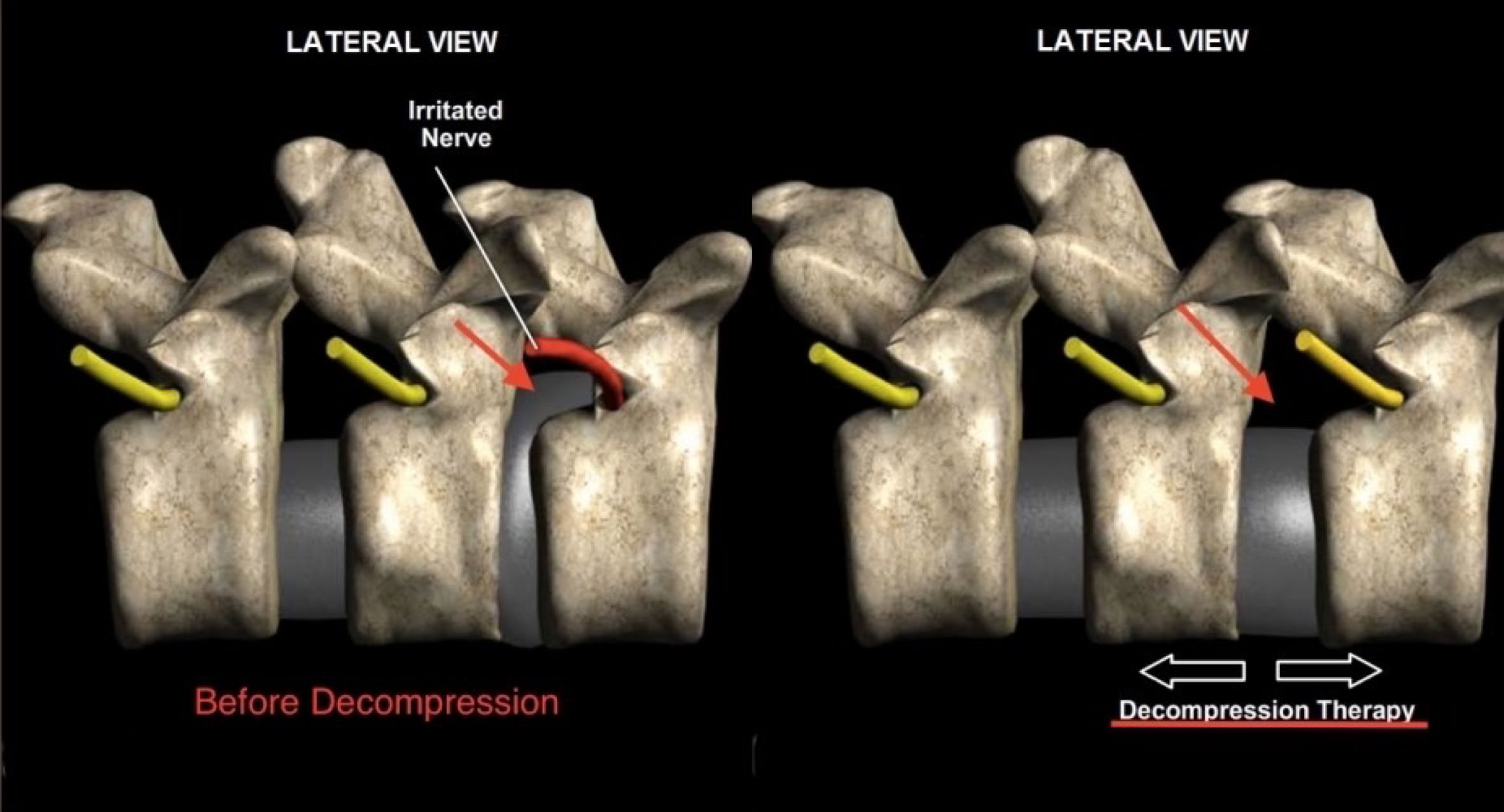 Decompression Before and After Non-Surgical Spinal Decompression Centre Melbourne Australia