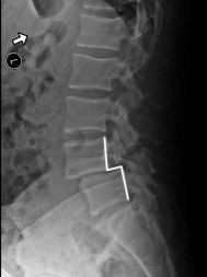 Pars-Defect-xrays-spondylolisthesis.