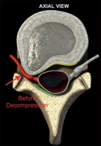 Disc-Herniation