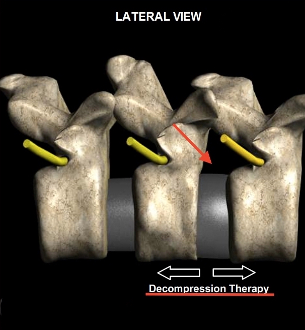After-Decompression-lateral-View