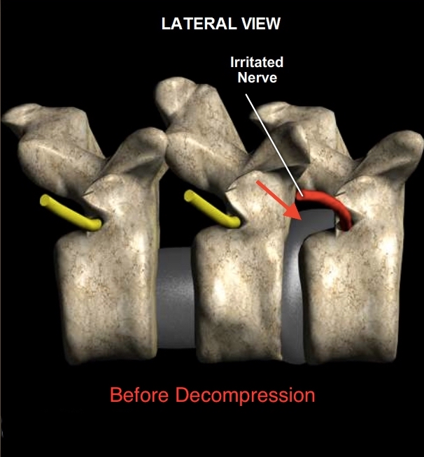 Before-Decompression-lateral-View
