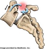 Medtronic_spondylolisthesis_unstable_150_162_80