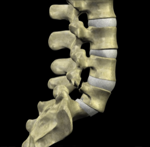 Spondylolisthesis