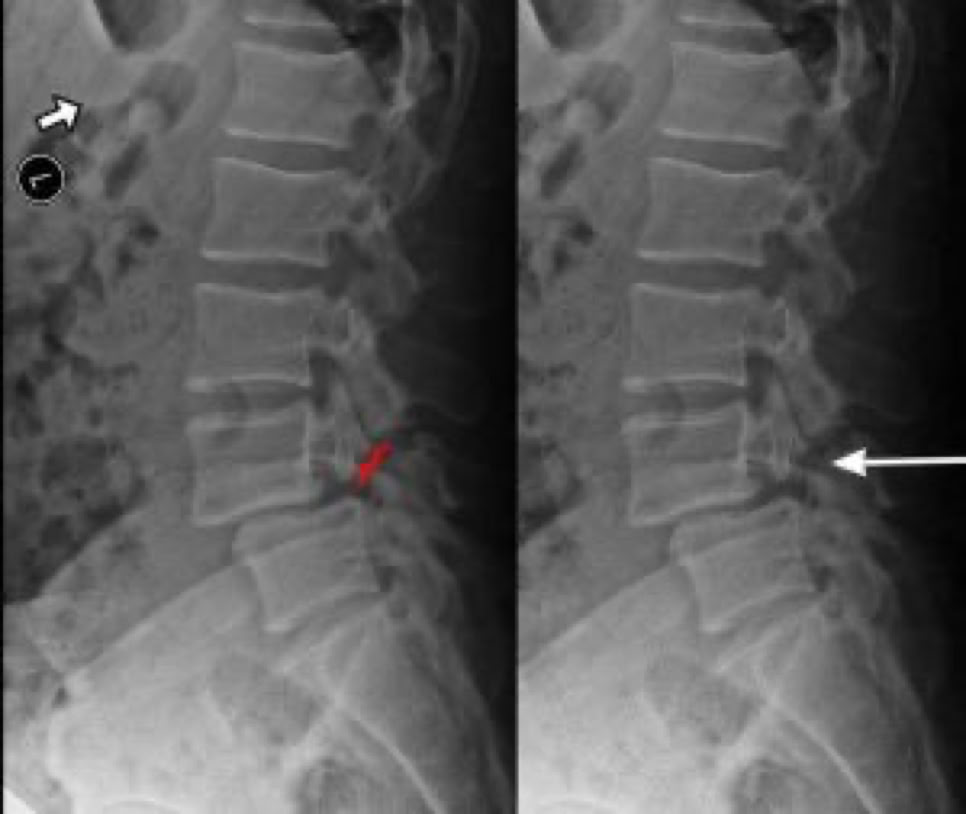 fracture of the pars defect