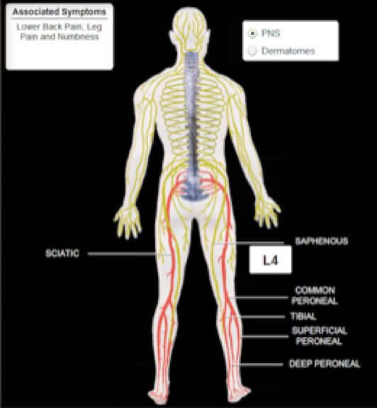 lumbar radiculopathy picture