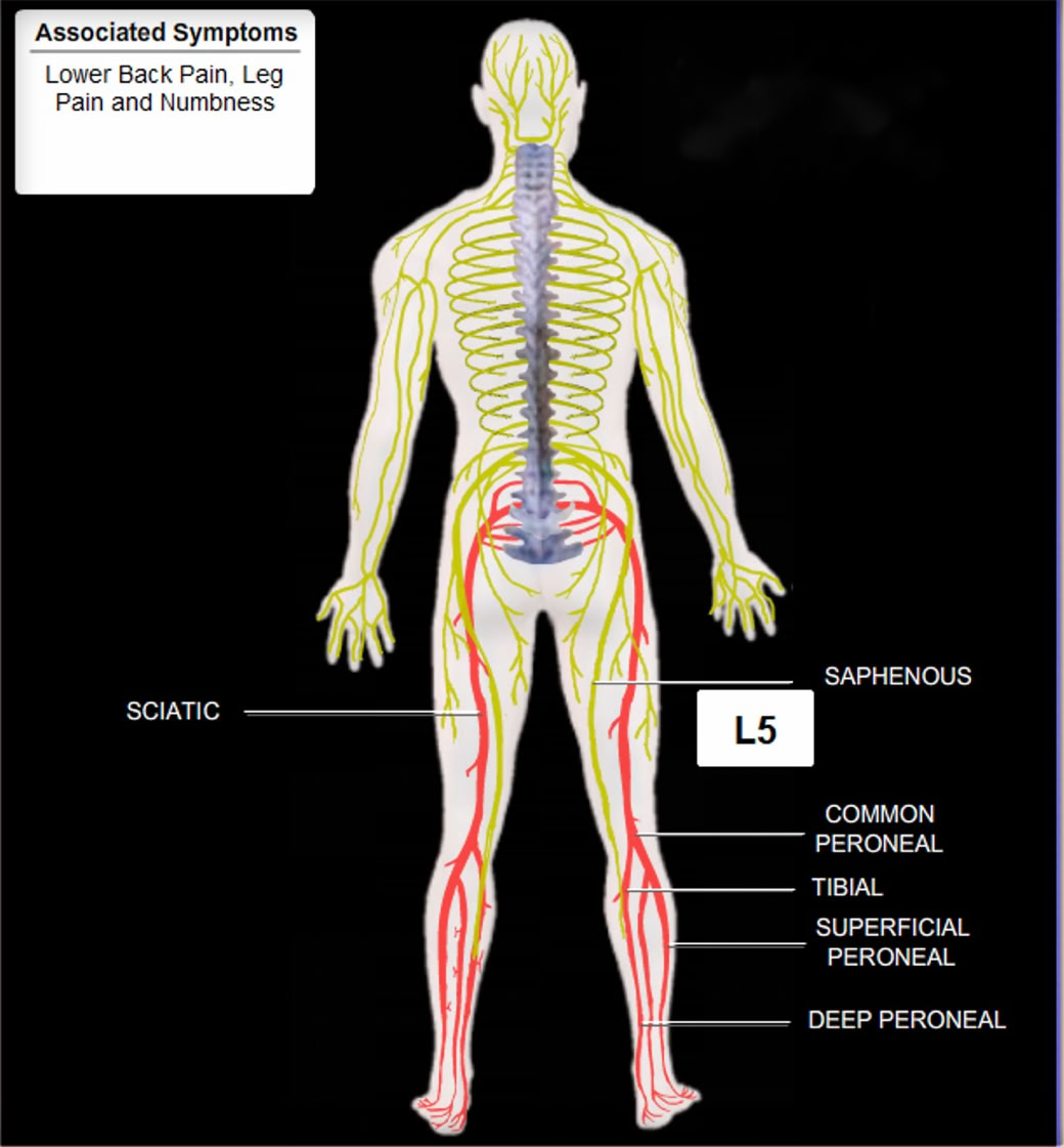 symptoms radiation due to L5 compressed nerve