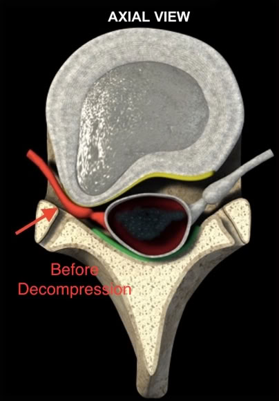 disc herniation picture