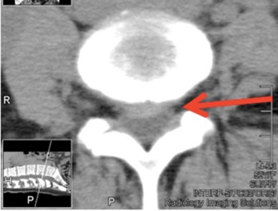 Spinal canal Stenosis on CT
