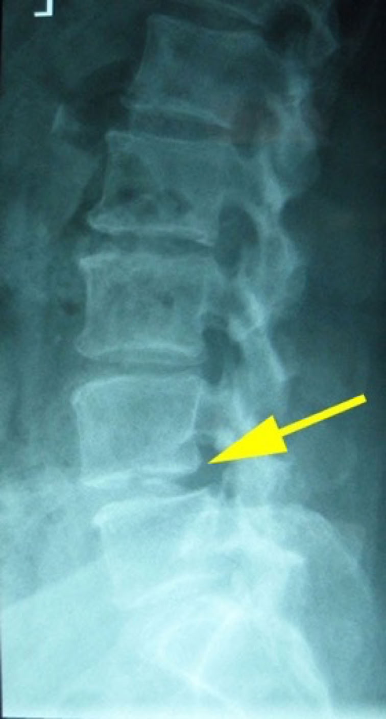 Spinel Canal Stenosis on xrays