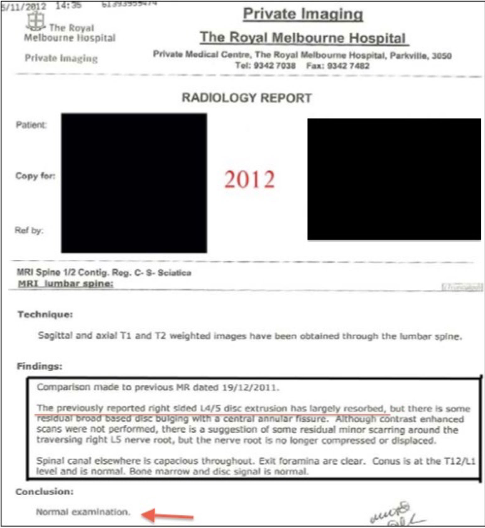 MRI before and after Non-Surgical Spinal Decompression